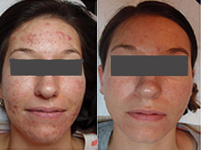 acne treatment Colchester Essex