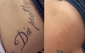 LASER TATTOO REMOVAL COLCHESTER ESSEX - From £49