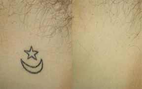 Laser Tattoo Removal Colchester